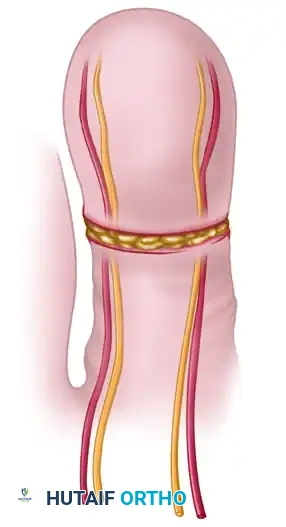 FIRST WEB SPACE, PULP, AND HEMIPULP NEUROVASCULAR FREE FLAPS Surgical Diagram
