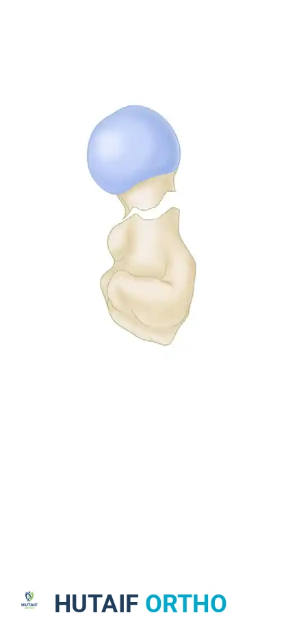 FIXATION OF FEMORAL NECK FRACTURE WITH CANNULATED SCREWS Surgical Diagram