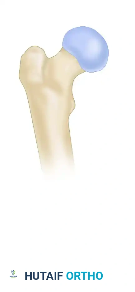 FIXATION OF FEMORAL NECK FRACTURE WITH CANNULATED SCREWS Surgical Diagram