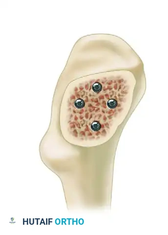 FIXATION OF FEMORAL NECK FRACTURE WITH CANNULATED SCREWS Surgical Diagram