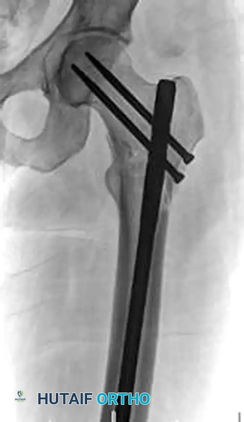 FIXATION OF SUBTROCHANTERIC FEMORAL FRACTURE WITH A PROXIMAL FEMORAL LOCKING PLATE Surgical Diagram