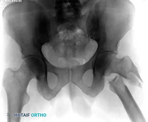 Mastering Subtrochanteric Femoral Fracture Fixation With a Proximal Femoral Locking Plate