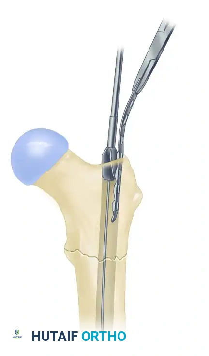 FIXATION OF SUBTROCHANTERIC FEMORAL FRACTURE WITH A PROXIMAL FEMORAL LOCKING PLATE Surgical Diagram