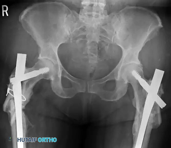 FIGURE 55-46 To correct suboptimal portal, a small plate can be placed in reamed lateral track and more medial portal established. (Redrawn from Gardner MJ, Henley HB: Harborview illus­ trated tips and tricks in fracture surgery , Philadelphia, 2010, Lippincott Williams and Wilkins.)