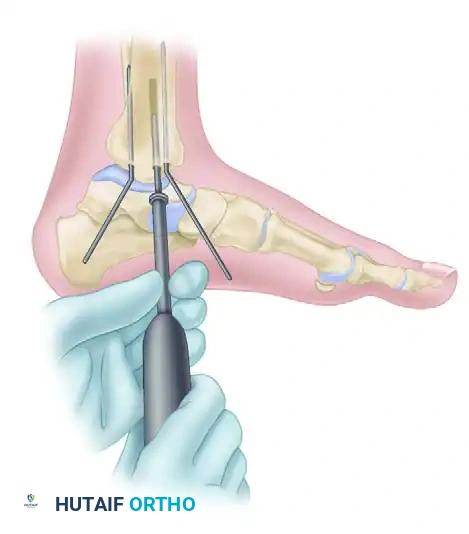 FIXATION OF THE LATERAL MALLEOLUS Surgical Diagram