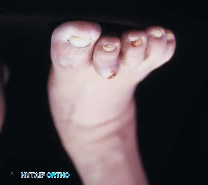 FIXED DEFORMITIES IN THE DIABETIC FOOT Surgical Diagram