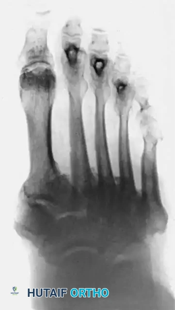 FIXED DEFORMITIES IN THE DIABETIC FOOT Surgical Diagram