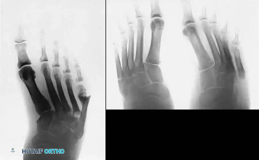 FIXED DEFORMITIES IN THE DIABETIC FOOT Surgical Diagram