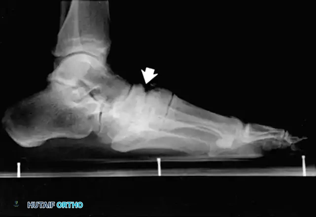 FIXED DEFORMITIES IN THE DIABETIC FOOT Surgical Diagram