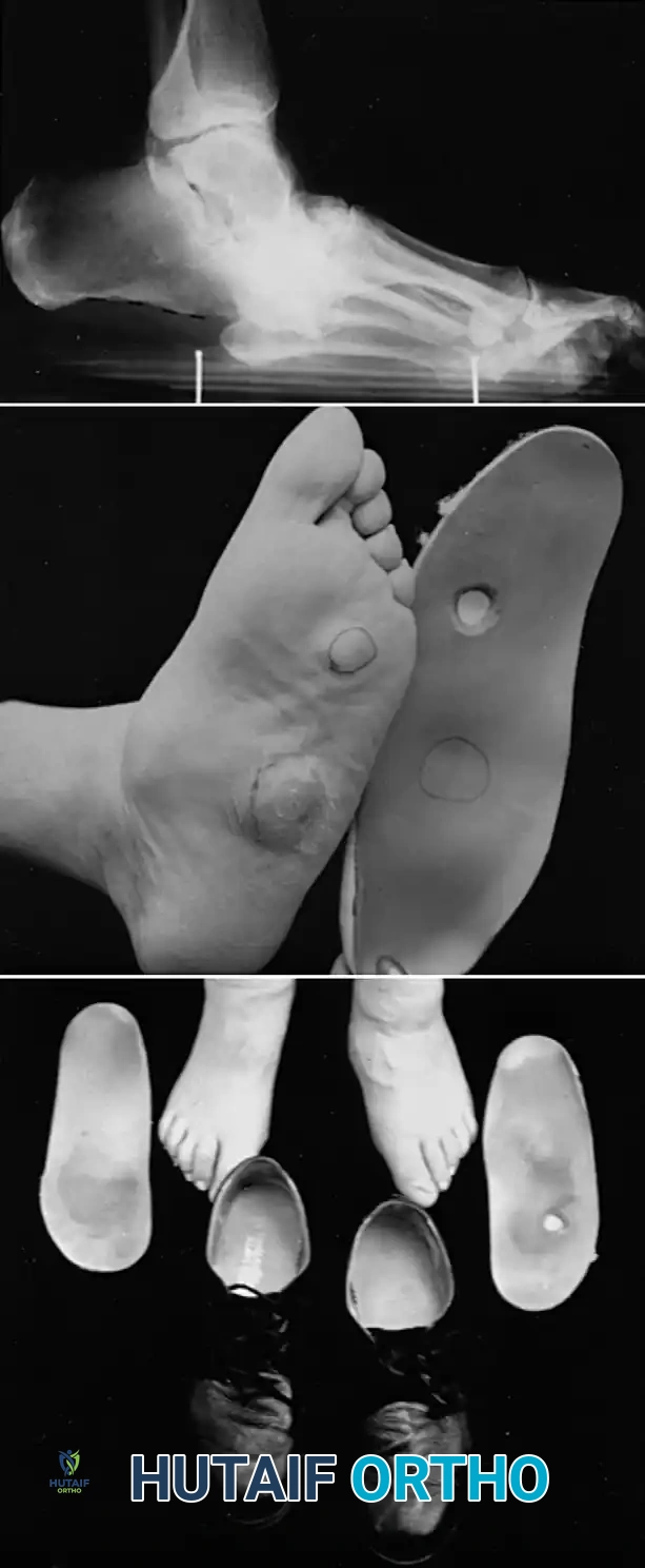 FIXED DEFORMITIES IN THE DIABETIC FOOT Surgical Diagram