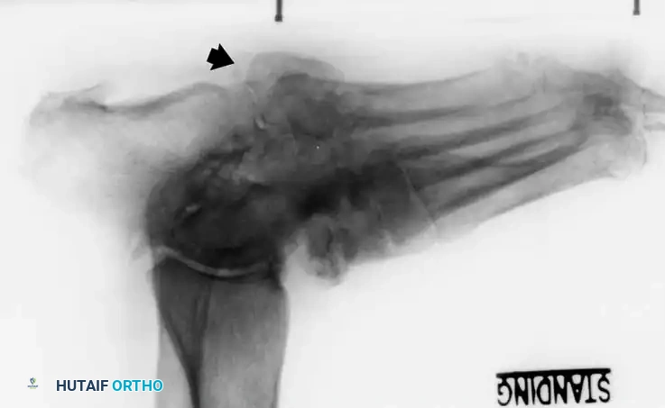 FIXED DEFORMITIES IN THE DIABETIC FOOT Surgical Diagram