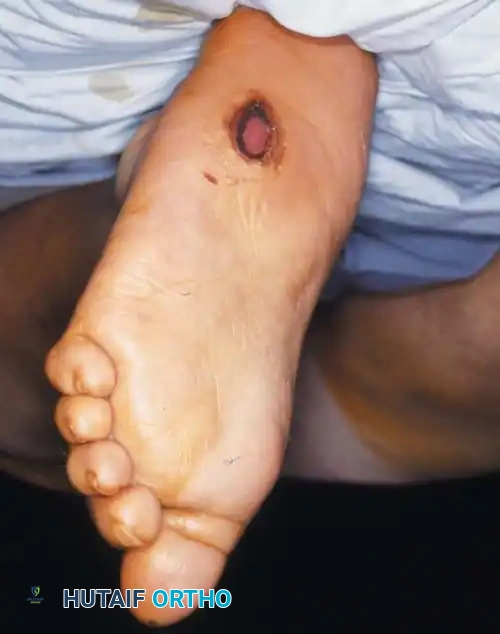 FIXED DEFORMITIES IN THE DIABETIC FOOT Surgical Diagram