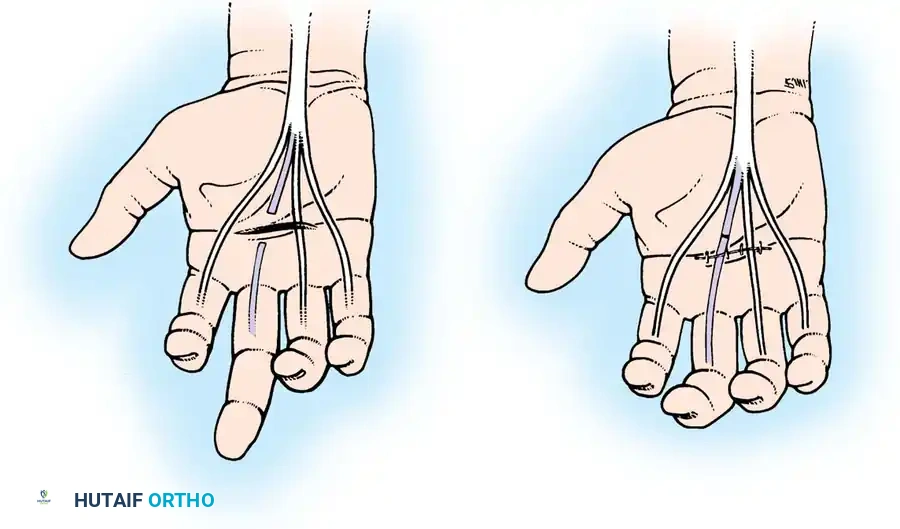 Flexor and Extensor Tendon Injuries Surgical Diagram