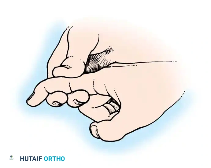 Fig. 63-3 If distal interphalangeal joint can be actively ﬂ exed while proximal interphalangeal joint is stabilized, profundus tendon has not been severed.