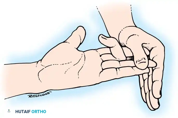 Fig. 63-4 If proximal interphalangeal joint can be actively ﬂ exed while adjacent ﬁ ngers are held completely extended, sublimis tendon has not been severed (see text).