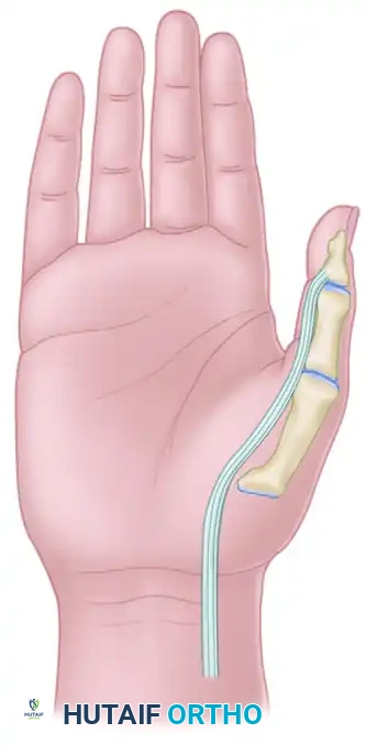 Operative Management of Thumb Deformities: Flexor Pollicis Longus Abductorplasty and Extensor Pollicis Longus Redirection