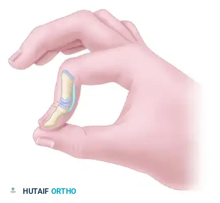 FLEXOR TENOLYSIS AFTER REPAIR AND GRAFTING Surgical Diagram