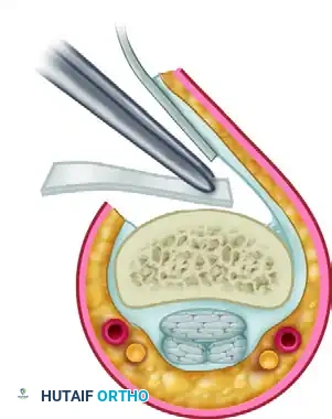 Adhesions Silastic sheet