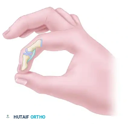 FLEXOR TENOLYSIS AFTER REPAIR AND GRAFTING Surgical Diagram