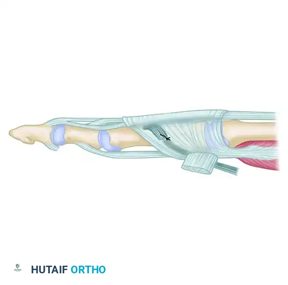 FLEXOR-TO-EXTENSOR TRANSFER Surgical Diagram
