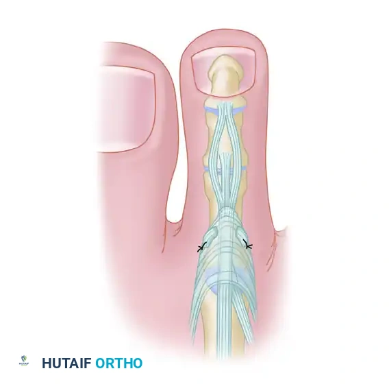 FLEXOR-TO-EXTENSOR TRANSFER Surgical Diagram