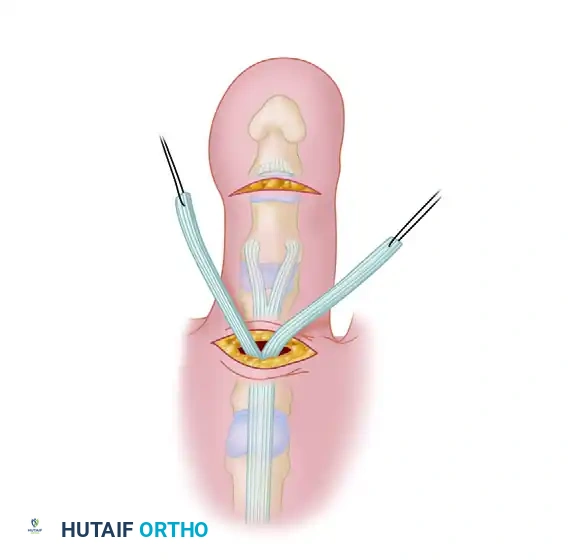 FLEXOR-TO-EXTENSOR TRANSFER Surgical Diagram