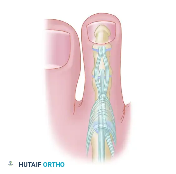 FLEXOR-TO-EXTENSOR TRANSFER Surgical Diagram