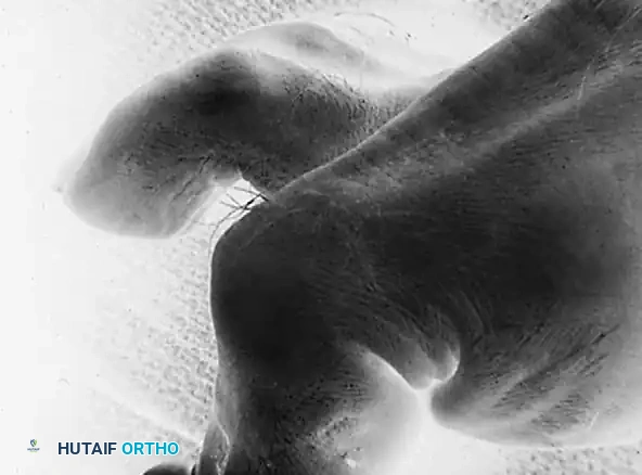 FLEXOR-TO-EXTENSOR TRANSFER Surgical Diagram