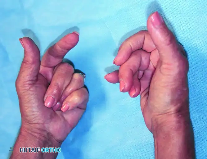 Focal Dystonia, Factitious Disorders, and Psychogenic Postures of the Hand