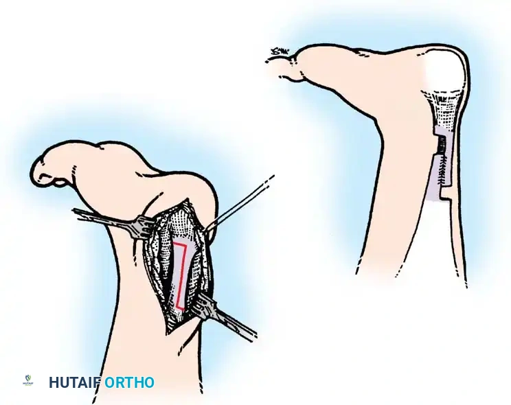 رسم توضيحي لتقنية التطويل على شكل حرف زد