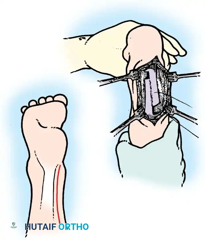 رسم يوضح تقنية الانزلاق لتطويل وتر أخيل