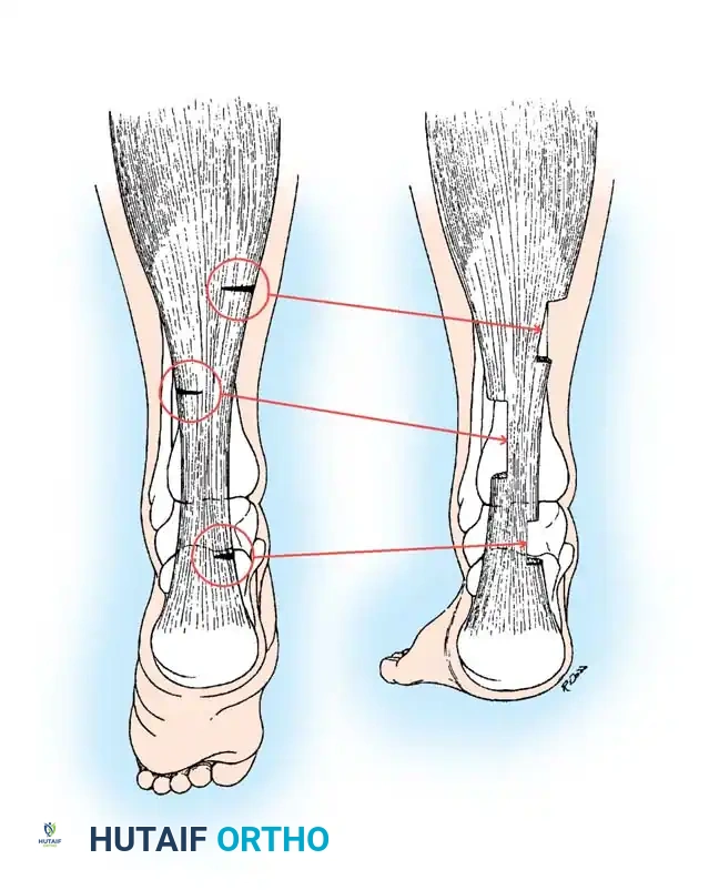 رسم يوضح أماكن الشقوق الصغيرة في التطويل عن طريق الجلد