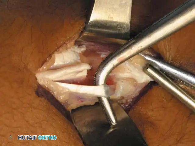 إجراء الشقوق الدقيقة عن طريق الجلد