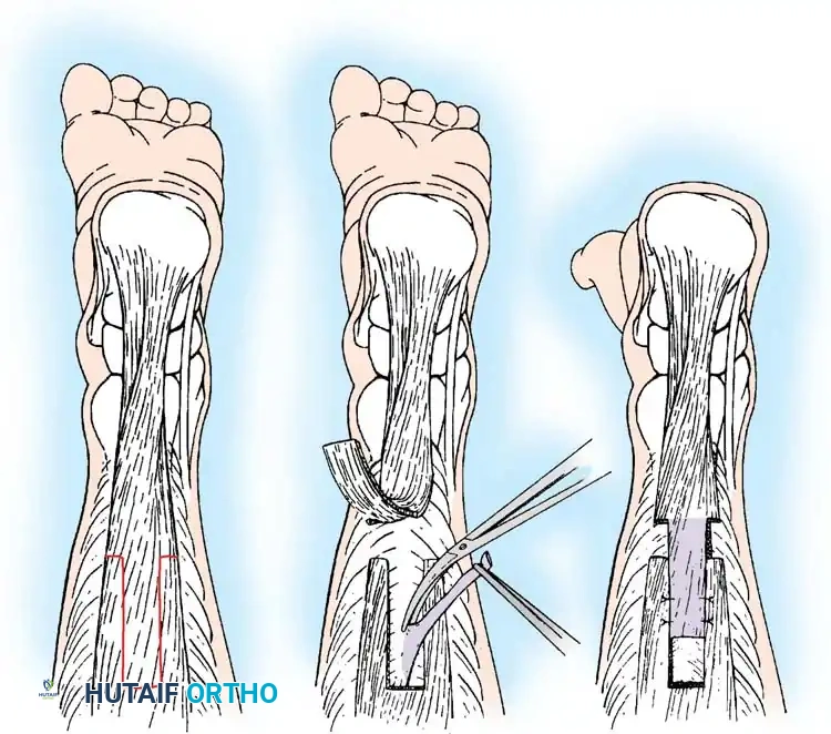 تفاصيل جراحية لإطالة الغشاء العضلي