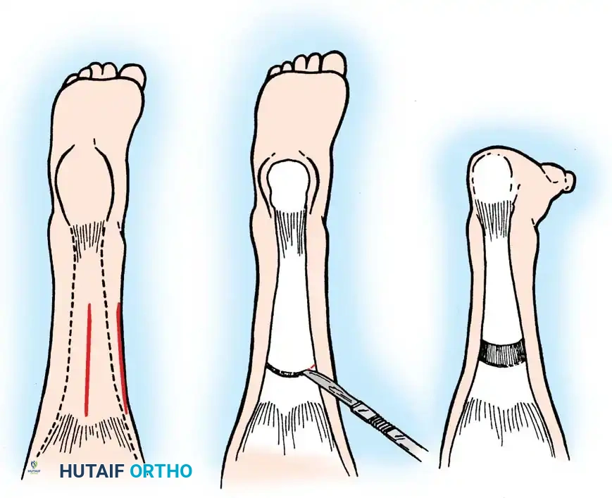تثبيت العظام بعد التصحيح