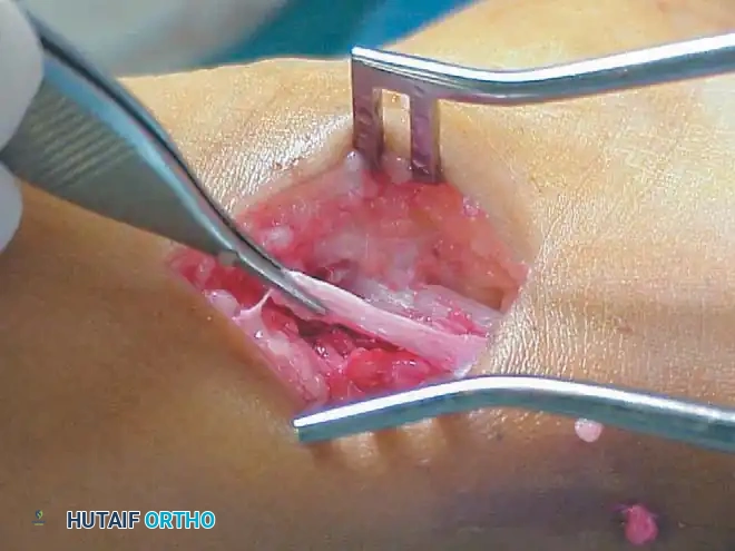 خطوات عملية إطالة عضلة الساق