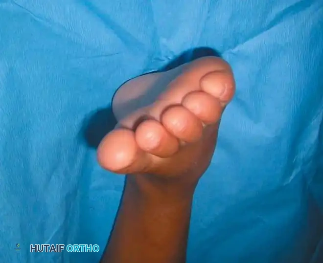 النتيجة النهائية بعد خياطة الوتر