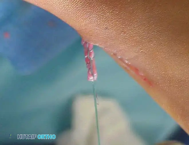 استكمال تقنية تطويل الوتر