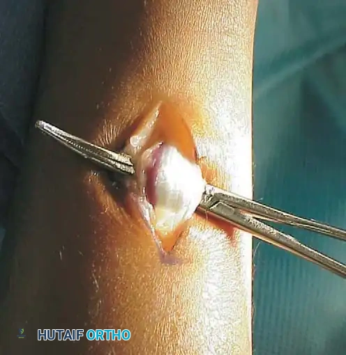 رسم يوضح إطالة عضلة الساق الخلفية