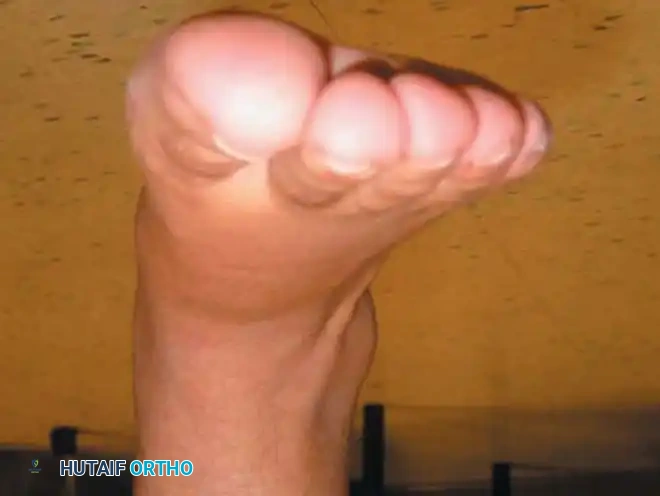 وضع الساق بعد الجراحة