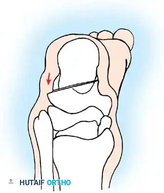 استكمال خطوات الجراحة للعضلة
