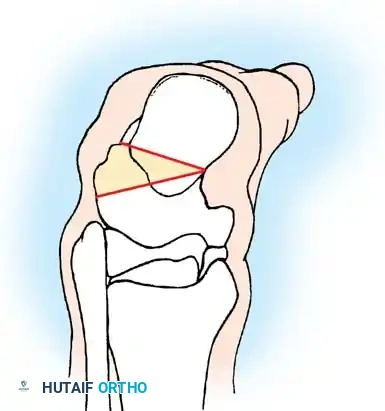 خطوات جراحية لتطويل الوتر المفتوح