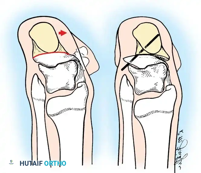 النتيجة النهائية والتجبير