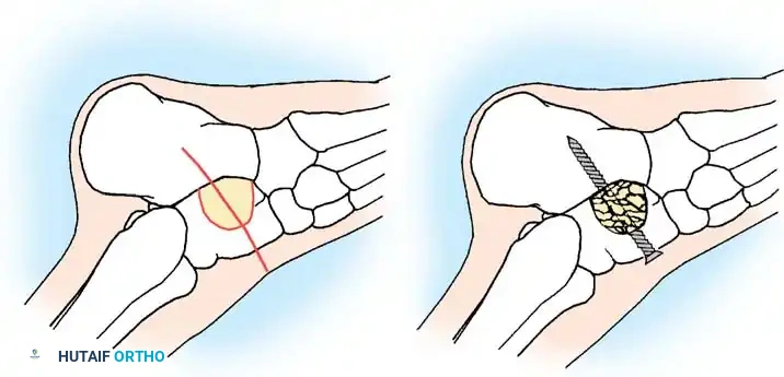 النتيجة بعد التطويل عن طريق الجلد