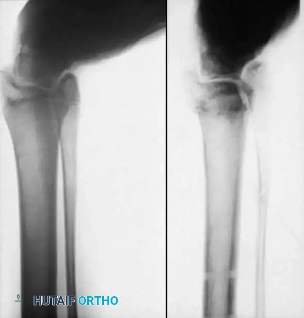 خطوات جراحية لتصحيح اعوجاج القدم