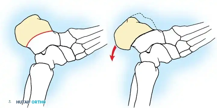 رسم يوضح انحراف القدم والتدخل العظمي