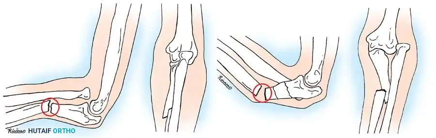 Pediatric Forearm Fractures: Comprehensive Operative and Closed Management