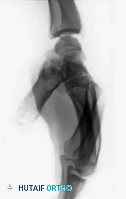 Fig. 64-31 Dislocation of fourth and ﬁ fth carpometacarpal joints. A, Clinical appearance of hand before reduction. Note dorsoulnar hand swelling consistent with injury. B, Posteroanterior view. C, Lateral view. D, Oblique view. E and F, Traction was adequate to reduce, and splint was satisfactory to maintain reductions.