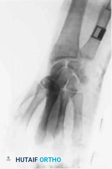 Fig. 64-31 Dislocation of fourth and ﬁ fth carpometacarpal joints. A, Clinical appearance of hand before reduction. Note dorsoulnar hand swelling consistent with injury. B, Posteroanterior view. C, Lateral view. D, Oblique view. E and F, Traction was adequate to reduce, and splint was satisfactory to maintain reductions.