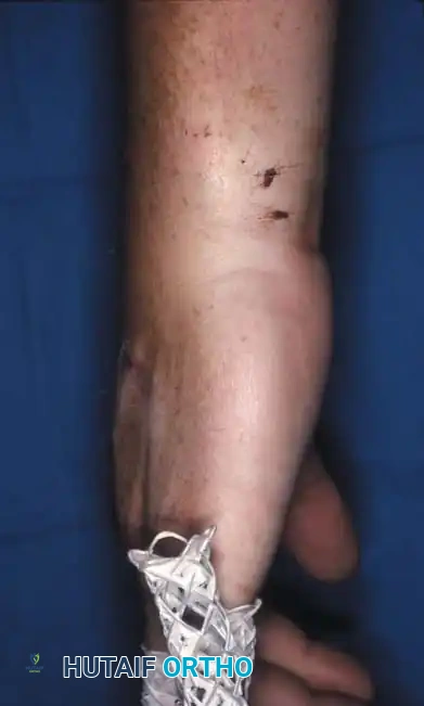 Fig. 64-31 Dislocation of fourth and ﬁ fth carpometacarpal joints. A, Clinical appearance of hand before reduction. Note dorsoulnar hand swelling consistent with injury. B, Posteroanterior view. C, Lateral view. D, Oblique view. E and F, Traction was adequate to reduce, and splint was satisfactory to maintain reductions.